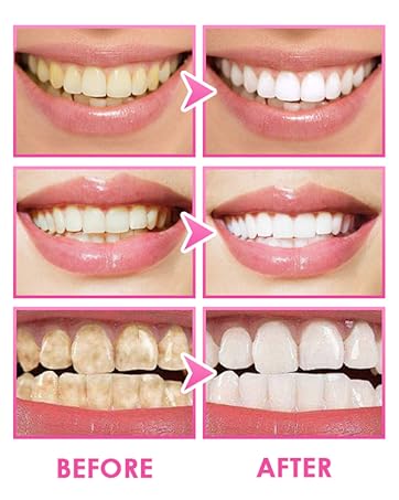 BANDES DE BLANCHIMENT DENTAIRE - 5D WHITE